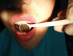 《震撼！牙结石清洗全纪录》-小文资源网